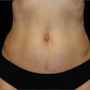 After RF microneedling skin rejuvenation treatment at Metropolitan Med Spa in Lorton, VA