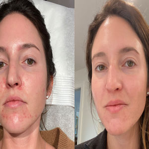 PCA Peel with Retinol(001)
