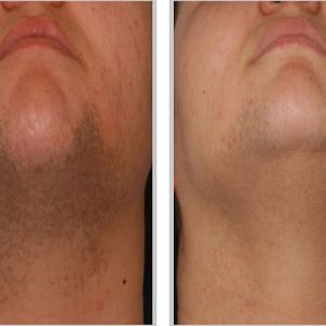 Chin(001)
