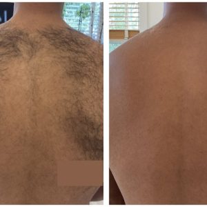 Back (Upper)(001)