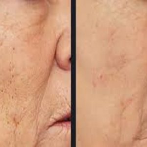 Melasma treatment with RF Microneedling(001)