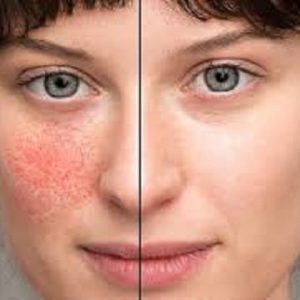 Rosacea Treatment with RF Microneedling(001)