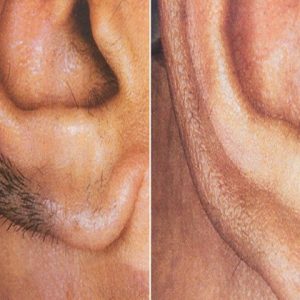 Ear(001)